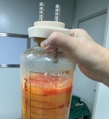 华容水动力吸脂手术要做多久？
